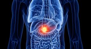 Eletroporação no tratamento do câncer de pâncreas: esperança em meio aos desafios de um dos tumores mais agressivos